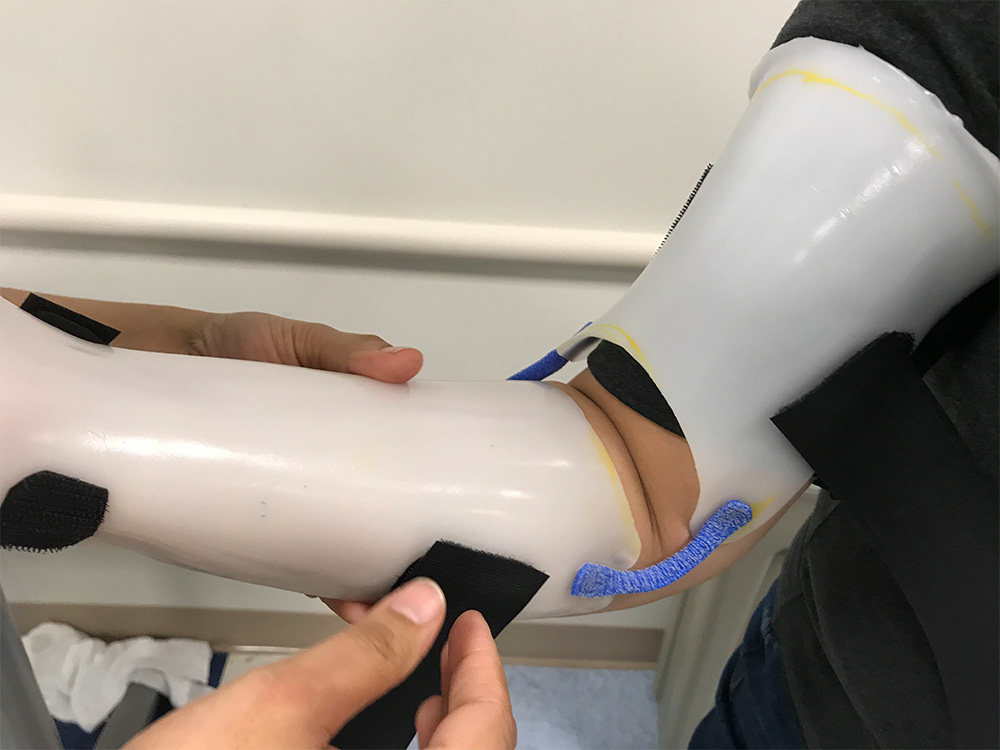 Static progressive orthosis with an Orficast hinge.