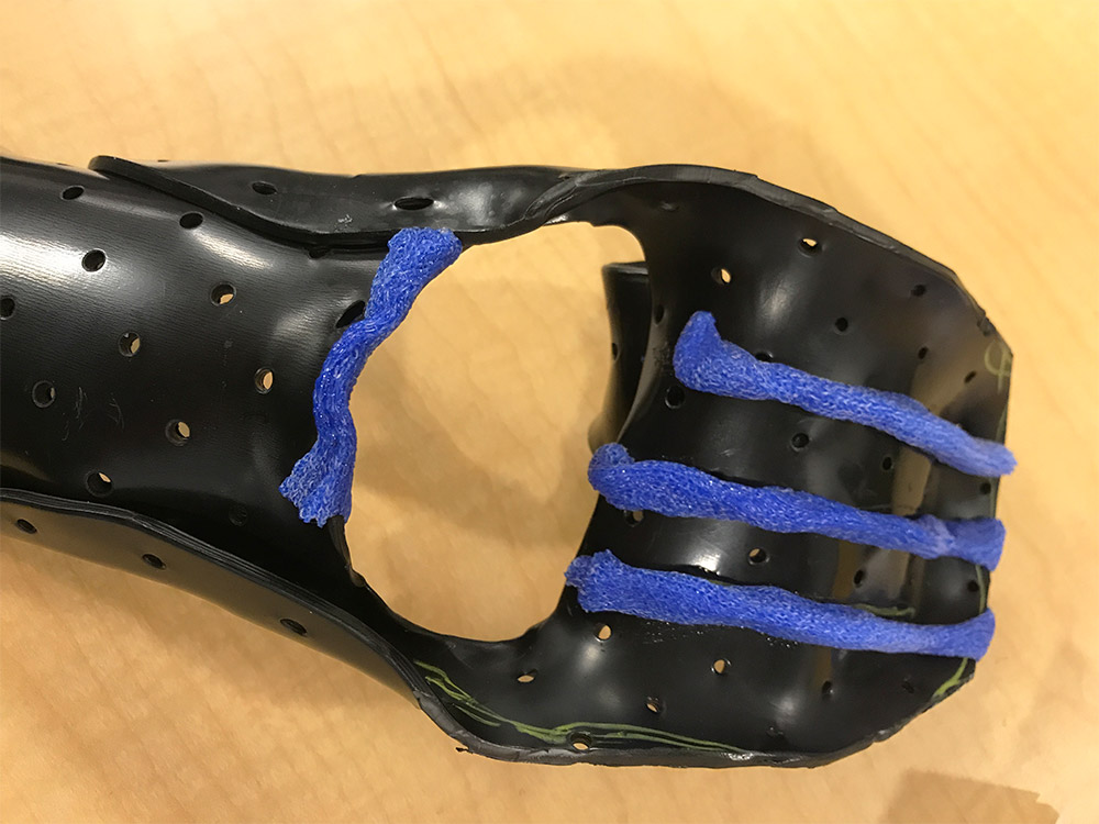 A resting hand orthosis with Orficast separators.