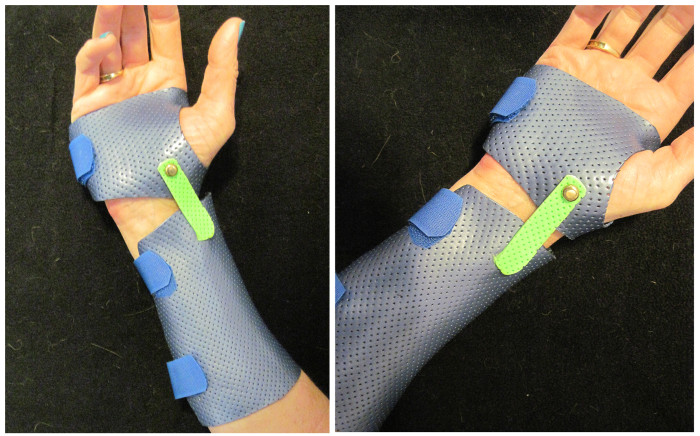 Dart Thrower's Motion Orthosis