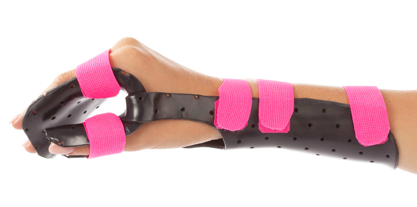 Arm with dorsal orthosis in Orfit Flex NS