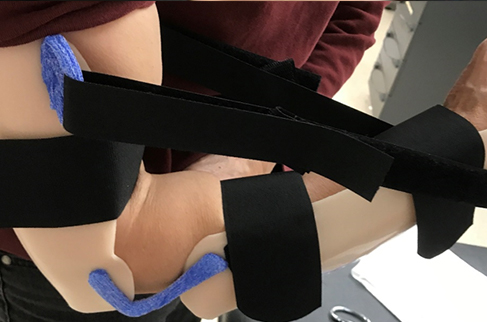 Woman wearing a thermoplastic static progressive elbow flexion orthosis.
