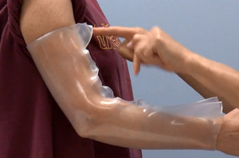 Molding thermoplastic material on a patient's arm