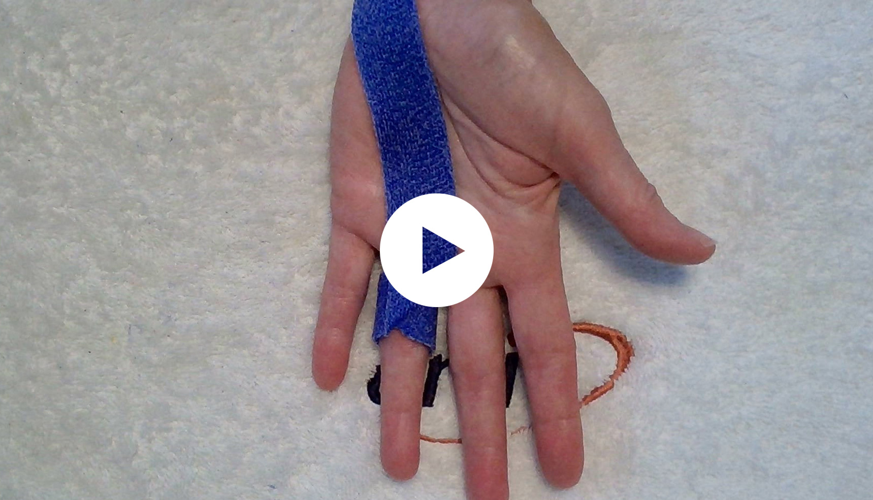 Trigger Finger Orthosis from Orficast video screenshot
