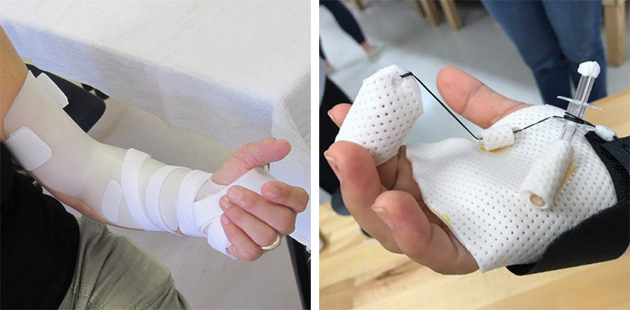 a static progressive elbow orthosis and finger orthosis
