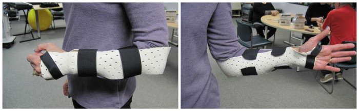 The Sugar Tong orthosis seen from two angles.