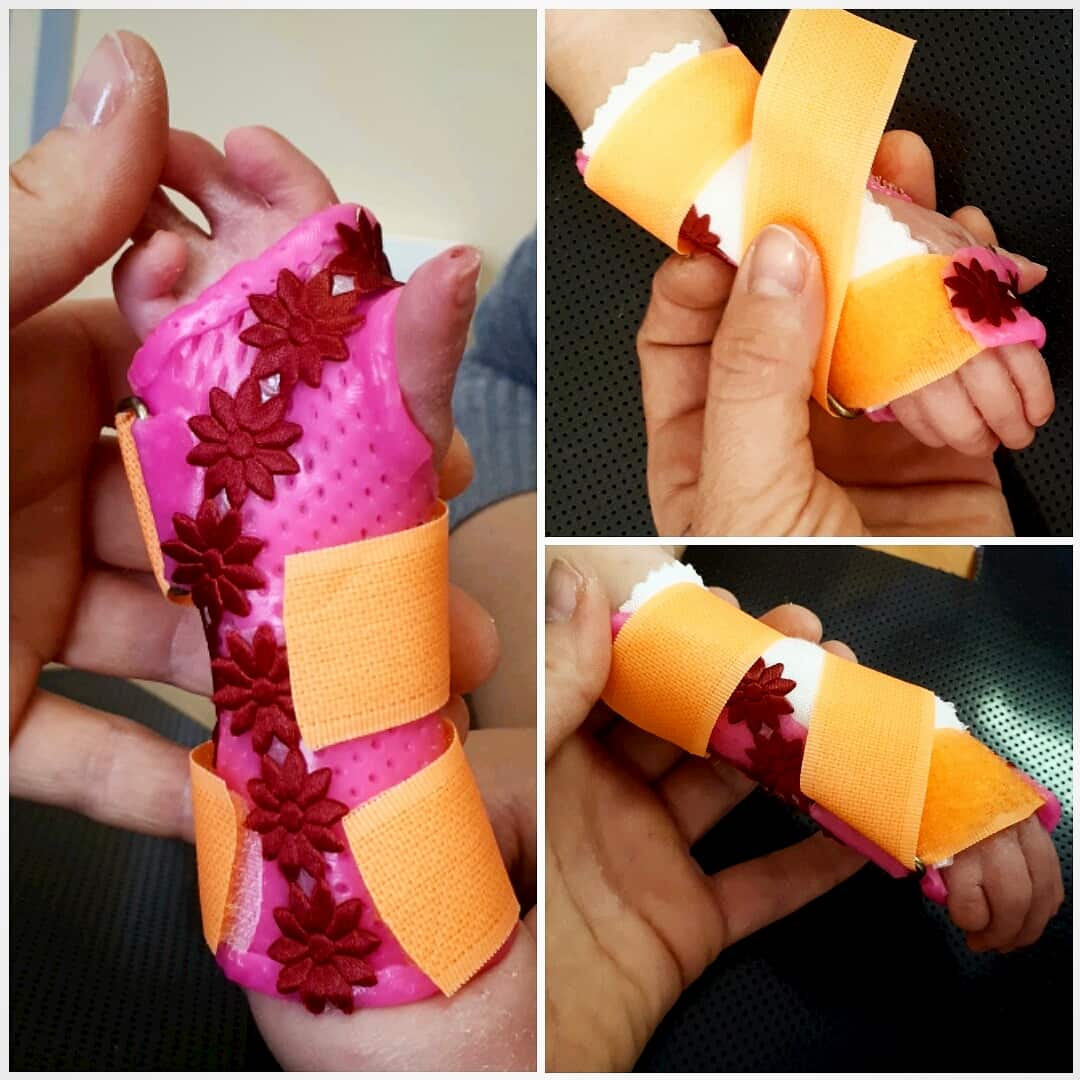 Orthosis for symbrahydactylycongenital malformation.