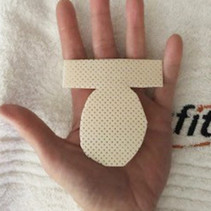Fabrication of an MCP joint blocking orthosis for trigger finger