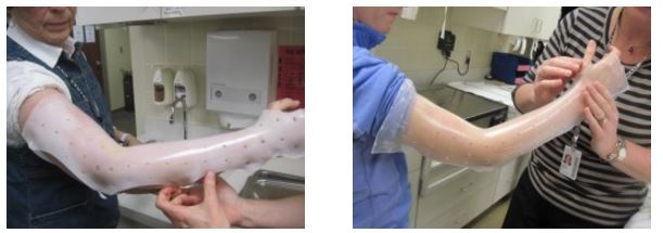circumferential elbow splint