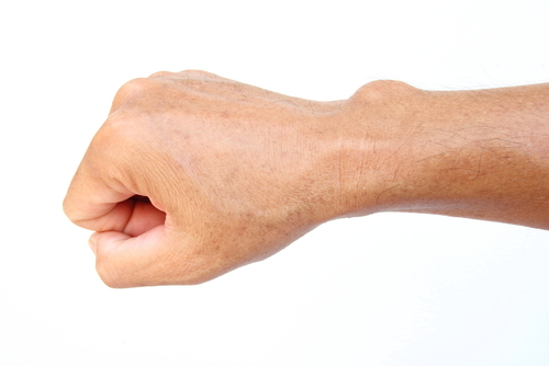 Ganglion cysts in the wrist